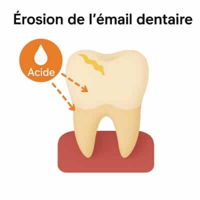 Érosion de l'émail dentaire causée par l'acidité