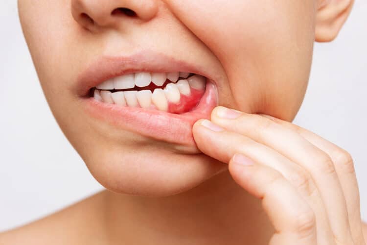 Déchaussement des dents chez l'adulte