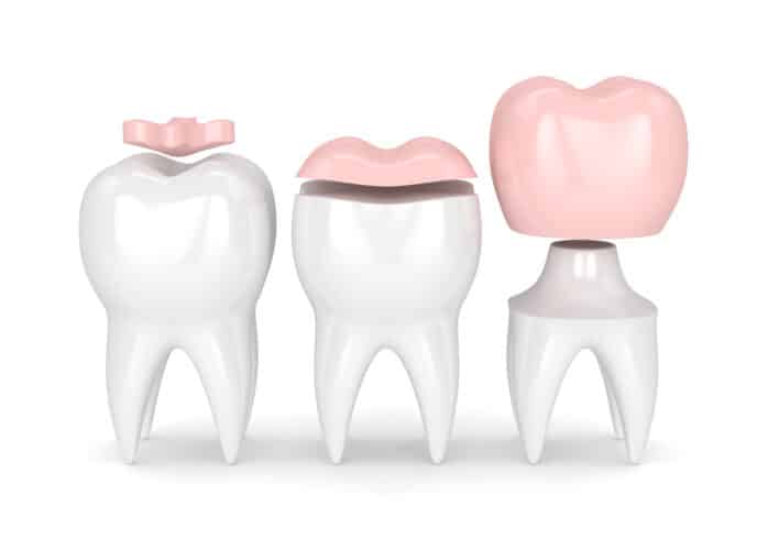 Inlays et Onlays représentés en 3D