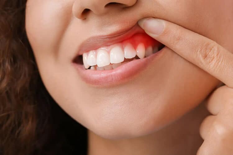 Tout savoir sur la gingivite