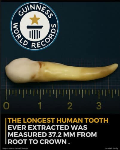 Record de la dent la plus longue du monde